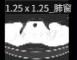 1.25 x 1.25 肺窗缩略图